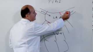 Pulmonary Vein Ablation and Atrial Fibrillation [upl. by Ykcul]