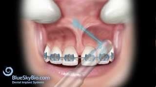 Patient Treatment Videos Frenectomy Laser [upl. by Anhcar]