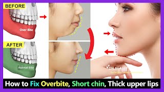 7 Steps How to Fix Overbite small chin big thick upper lip without braces naturally [upl. by Debbie]