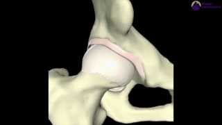 PincerType Femoroacetabular Impingement FAI [upl. by Annabal]