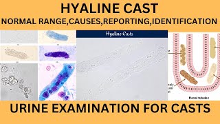 HYALINE CASTS IN URINECAUSES SYMPTOMS TREATMENT OF HYALINE CASTS IN URINE EXAMINATION IN HINDI [upl. by Chirlin]