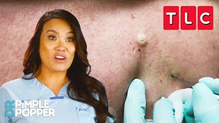 The BEST Blackhead Pops  Dr Pimple Popper  TLC [upl. by Bullough385]