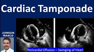 Cardiac Tamponade [upl. by Enomad22]