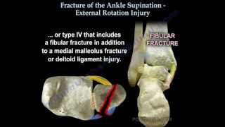 Ankle fracture  Supination External Rotation  Everything You Need To Know  Dr Nabil Ebraheim [upl. by Nally]