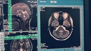 how to make mri orbit protocol and sequence n planning live demo [upl. by Tloc]