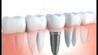 implant tedavisinin detaylı aşamaları 2 diş için [upl. by Macswan]