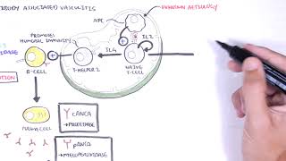 ANCA Associated Vasculitis AntiNeutrophil Cytoplasmic Antibody  Causes Pathophysiology Types [upl. by Zertnom]