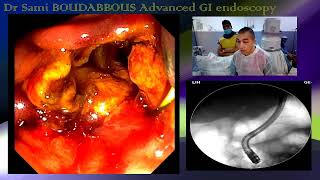 ERCP FOR ACUTE CHOLANGITIS [upl. by Nylrebmik]