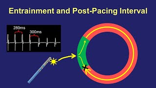 Entrainment Mapping The PostPacing Interval [upl. by Jaquenette734]