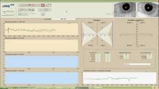 eVNG Caloric Test Demo [upl. by Asoramla]