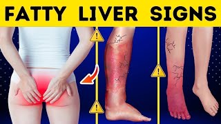 8 Skin signs of Liver Disease Fatty liver Cirrhosis of the Liver Fatty liver Symptoms [upl. by Raseta]