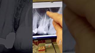 Does gutta percha extrusion cause endodontic failure [upl. by Naillig]