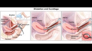 Gestational trophoblastic disease MANAGEMENT [upl. by Andel]