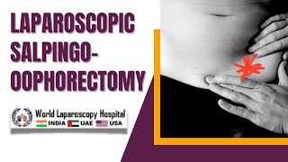 Laparoscopic Salpingooophorectomy for Recurrent Endometrioma A Comprehensive Video Overview [upl. by Lordan]