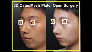 Osteomesh Chicago Nasal part 1 [upl. by Zeiler]