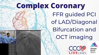 FFR guided PCI of LADDiagonal Bifurcation and OCT imaging  CCC Live April 2016 [upl. by Airdnaed]