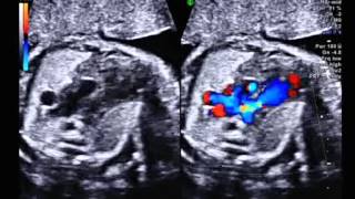 Tetralogy of Fallot with absent pulmonary valve syndrome 3 vessel view with colour [upl. by Tsyhtema]