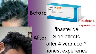 No Finasteride side effects after 4 years use and results EXPERIENCE Hair treatment part 5 [upl. by Lerad]