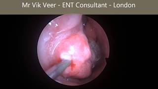 Watch an operation to unblock your nose  Celon radiofrequency ablation [upl. by Ailhat199]