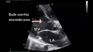 Tips and tricks of VSD echocardiography Ventricular Septal Defect [upl. by Ul]