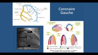 Coronarographie et Angioplastie coronaire [upl. by Nodarse]