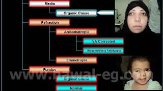 Strabismus Unilateral Decrease of VA Associated With Heterotropia [upl. by Johiah]