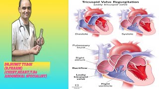 TRICUSPUD REGRATATION DISEASE BY DRSUMIT TYAGISUMITMEDICALDISPENSARY1 [upl. by Saisoj]