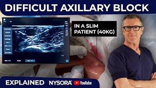 Slim but Tricky Axillary Block Challenges in Low BMI Patients [upl. by Amend]