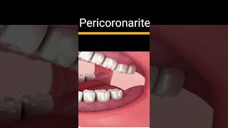 PERICORONARITE SABE O QUE É bucal odonto odontologia ortodontia dentist shortfeed SHORTS [upl. by Ivanah]