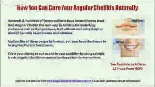 Angular Cheilitis NHS  BestAngularCheilitisTreatmentcom [upl. by Htebaile]