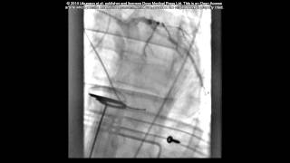 Case report PCI during cardiac arrest  Supplementary video 1 57953 [upl. by Gilbye190]