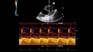 Ductus Arterioso Persistente [upl. by Behka]