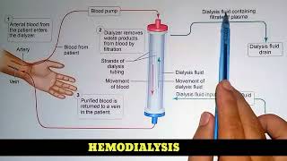 How To Hemodialysis Procedure Perform [upl. by Thalia]