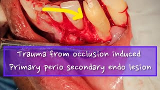 A case of management of trauma from occlusion [upl. by Oicnoel]