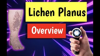 Lichen planus causes treatment diagnosis management [upl. by Aneetsirhc816]