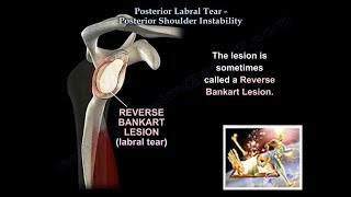 Posterior Labral Tear Shoulder Instability  Everything You Need To Know  Dr Nabil Ebraheim [upl. by Val136]