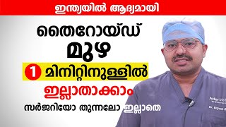 തൈറോയ്ഡ് മുഴ 1 മിനിറ്റിനുള്ളിൽ ഇല്ലാതാക്കാം സർജറിയോ തുന്നലോ ഇല്ലാതെ  Goiter Enlarged Thyroid [upl. by Torre523]