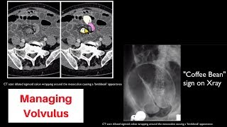 Volvulus sigmoid vs cecal vs gastric [upl. by Odama486]