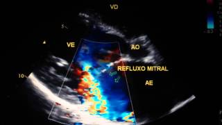 Insuficiência mitral importante [upl. by Balthasar]