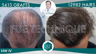 Injerto Capilar Técnica FUE – 5413 Grafts 12982 Pelos – Dr Rafael de Freitas [upl. by Tam]