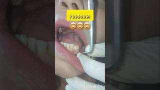 تركيبات اسنان ثابتة زيركون بورسلان جسر ثابت dentist stitch اكسبلور ترند stitchfan [upl. by Etrem]