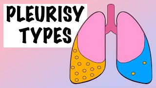 DIFFERENCES BETWEEN EXUDATIVE AND TRANSUDATIVE PLEURAL EFFUSION [upl. by Eisteb]