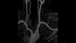 ANGIORMANATOMIA DOS VASOS CERVICAIS [upl. by Rebmac]