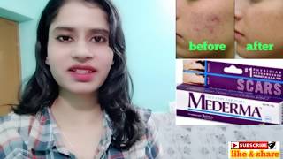 Mederma Gel full review with my experience  Scars  Stretch Marks treatment [upl. by Acsisnarf392]