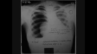 Hydropneumothorax  Lung collapse  role of Homeopathy [upl. by Viens466]