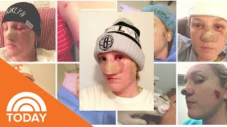 Melanoma Survivor Shares Her Story After Countless Skin Cancer Surgeries  TODAY [upl. by Onitnerolf813]