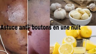 Comment éliminer les boutons en une nuit avec le citron et lail 😱 2Astuces incroyables [upl. by Amara]