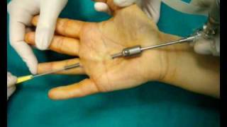 Endoscopic trigger finger [upl. by Silliw412]