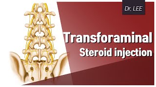 Technique of L5 transforaminal and L5S1 facet joint steroid injection in high iliac crest [upl. by Roslyn606]