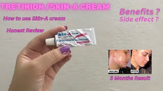 Skin A Cream Review  Acne Treatment at home  How to Use Tretinoin  Tretinoin Cream [upl. by Annaerdna]